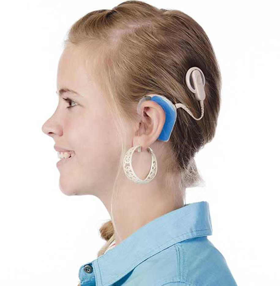 Cochlear-Implants-UCI-Head-Neck