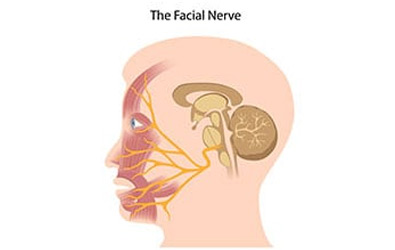 Facial-Nerve-Disorders