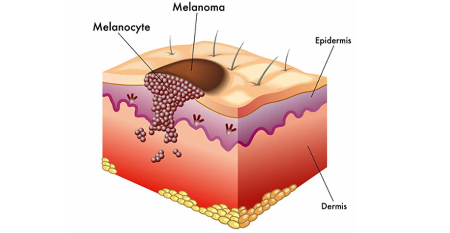 Melanoma | UCI Head and Neck Surgery - UCI ENT Doctors - Otolaryngologists