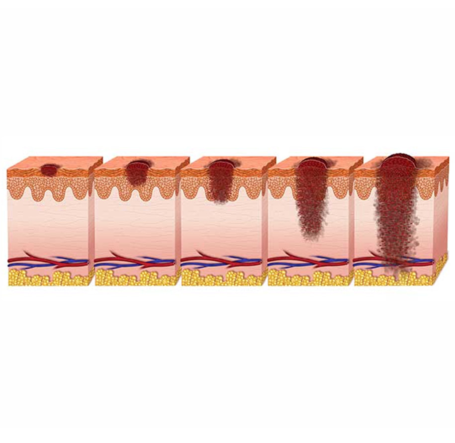 Melanoma | UCI Head and Neck Surgery - UCI ENT Doctors - Otolaryngologists