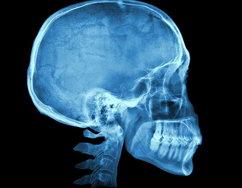 Minimally-Invasive-Endoscopic-Skull-Base-Surgery-UCI-Head-Neck