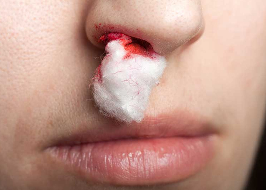 Nosebleeds-UCI-Head-&-Neck Nosebleeds-UCI-Head-&-Neck