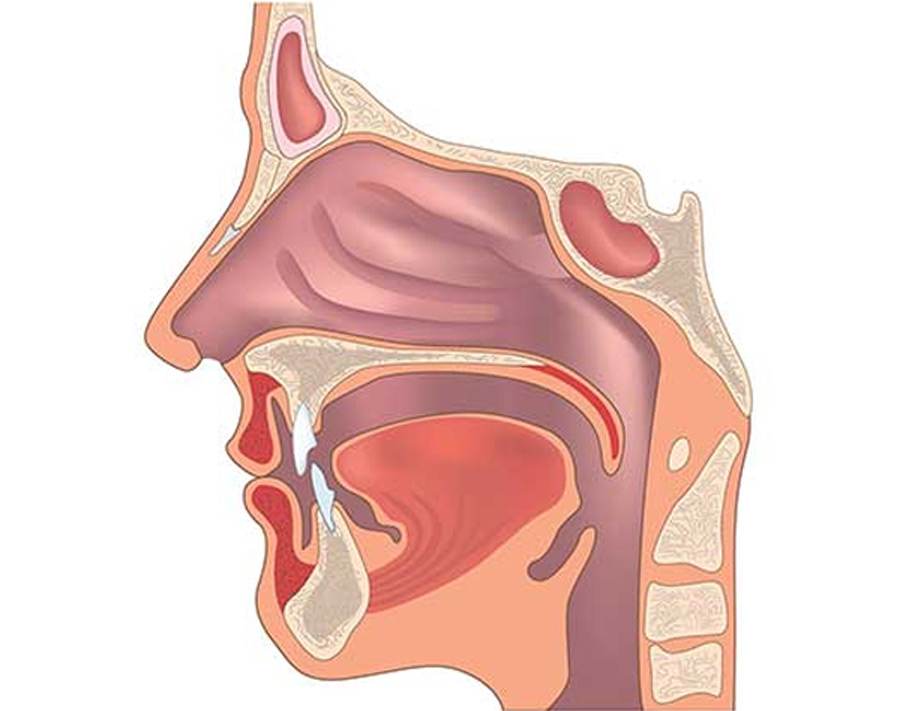 Superior-Canal-Dehiscence-UCI-Head-Neck