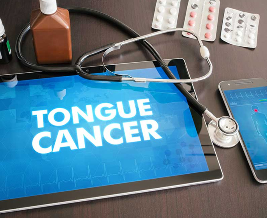 Tongue-Cancer-UCI-Head-&-Neck Tongue-Cancer-UCI-Head-&-Neck