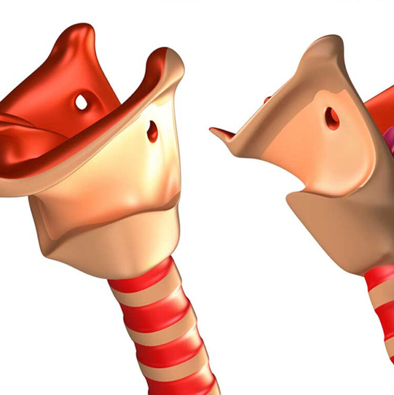 Vocal Cord Cyst UCI Head and Neck Surgery UCI ENT Doctors Otolaryngologists