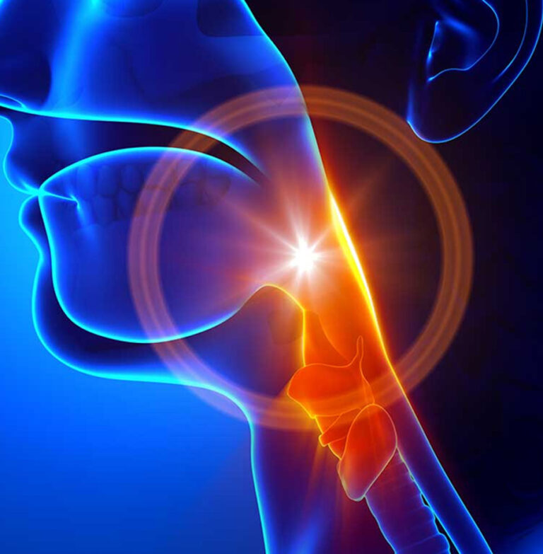 Vocal Cord Hemorrhage UCI Head and Neck Surgery UCI ENT Doctors