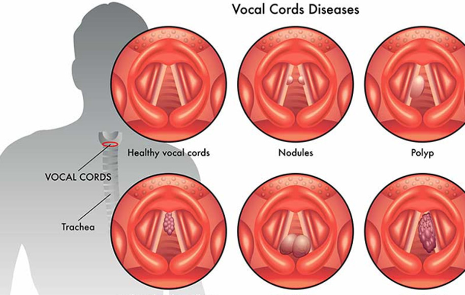 Vocal Cord Nodule UCI Head and Neck Surgery UCI ENT Doctors