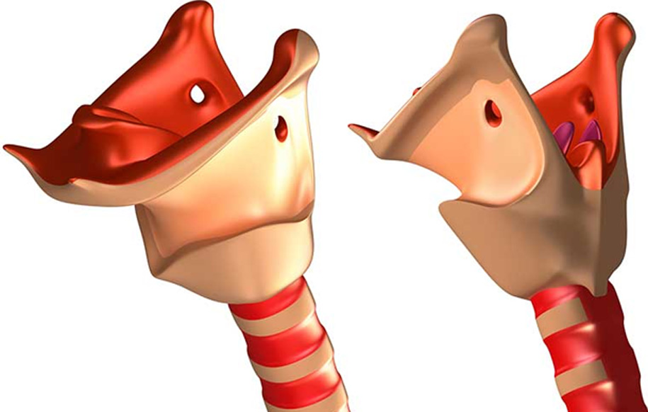 Vocal-Cord-Paralysis-UCI-Head-&-Neck Vocal-Cord-Paralysis-UCI-Head-&-Neck